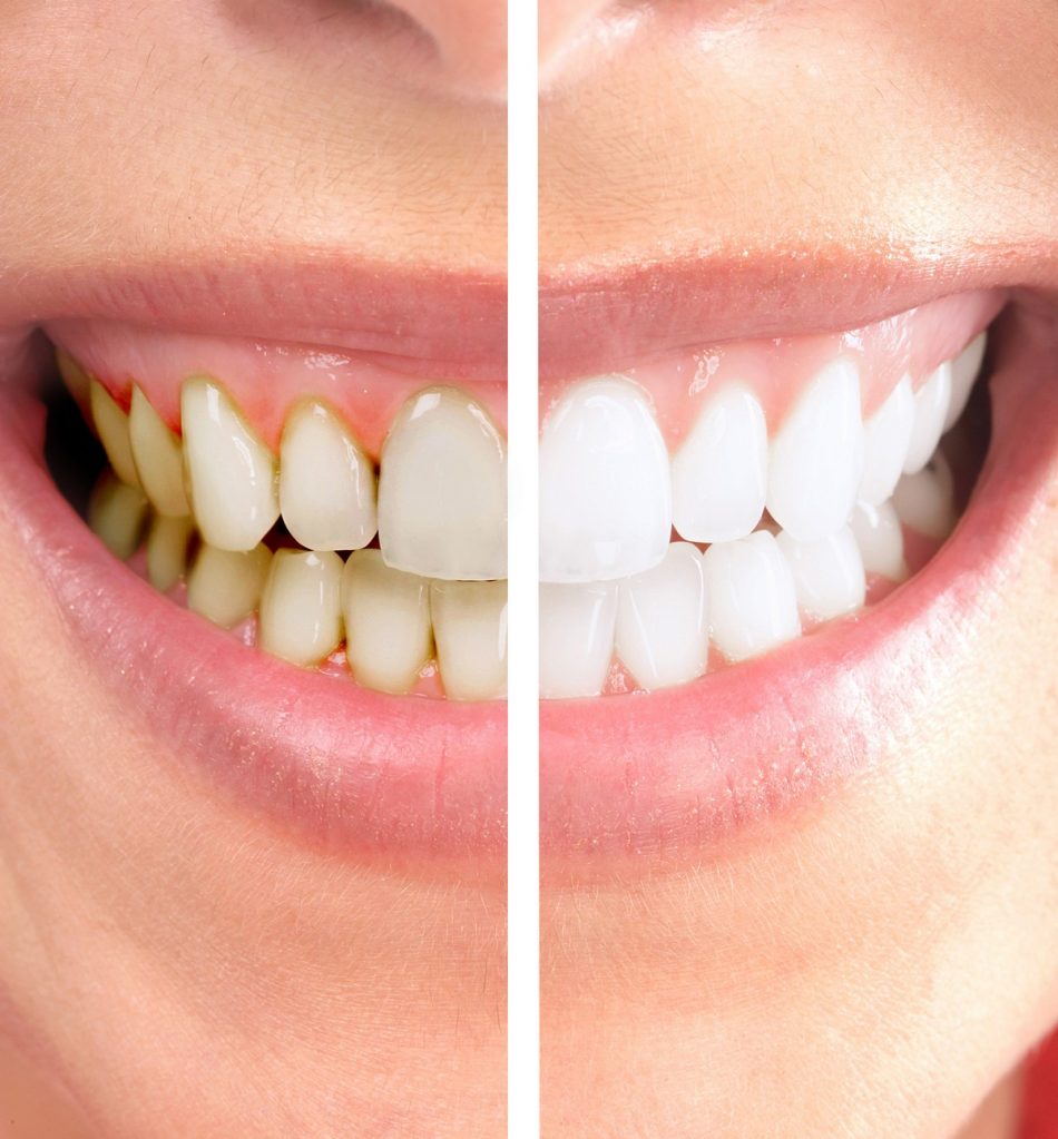 Tooth Whitening (Bleaching) Market Green Dental Care